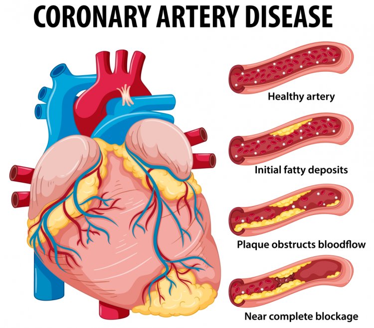 Guarding Your Arteries: Preventing and Treating Peripheral Artery Disease