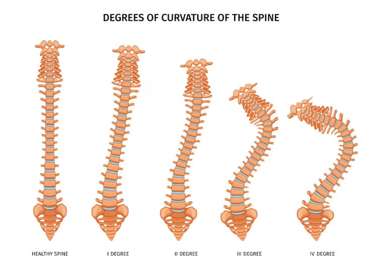 Degenerative and Rheumatologic Spinal Disorders