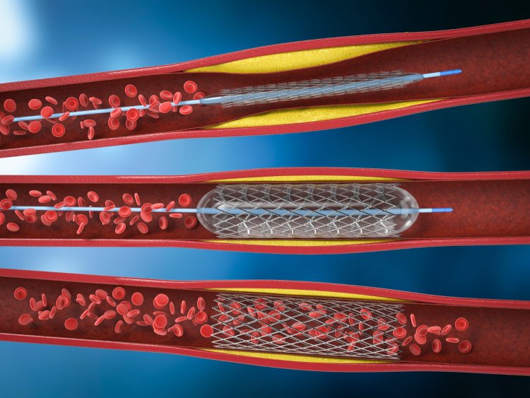 Angioplasty and Stenting: Lifesaving Procedures for Heart Health