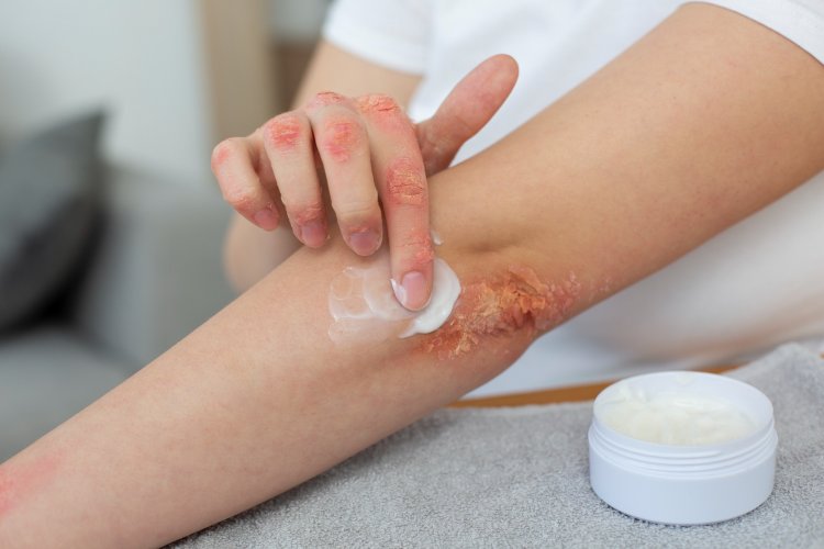 The Eczema Enigma: Uncovering Causes and Finding Solutions