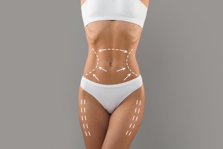 Fat Removal Revolution: The Advancements in Liposuction Technology