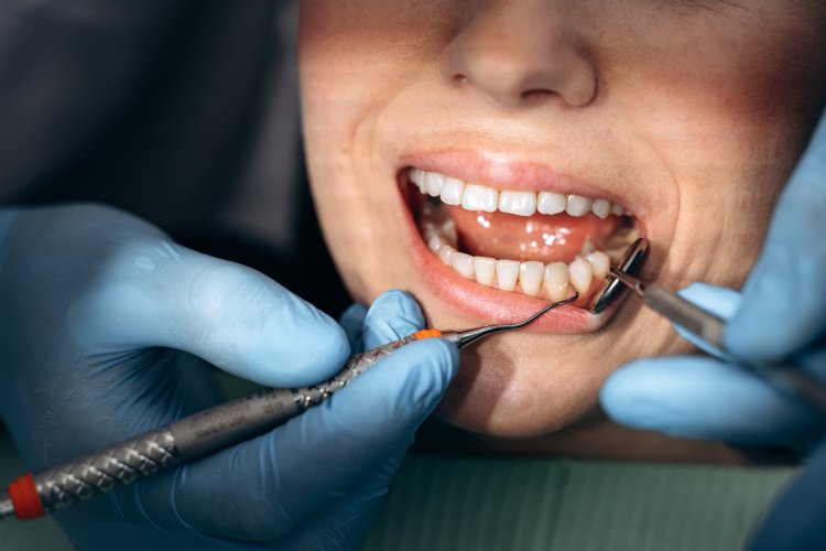 Tartar Trouble: Managing and Preventing Dental Buildup