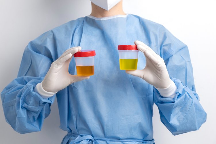 Blood in Your Urine: Decoding Haematuria's Signals