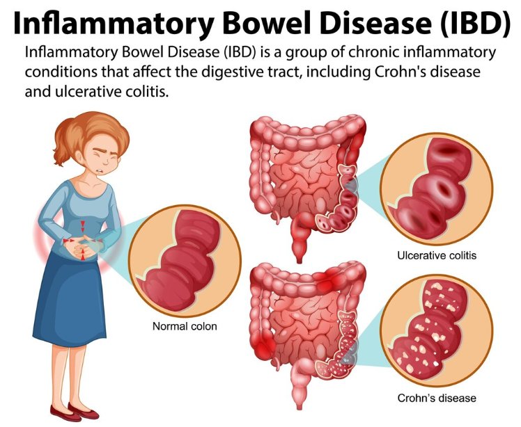 Gut Check: A Comprehensive Guide to Inflammatory Bowel Disease