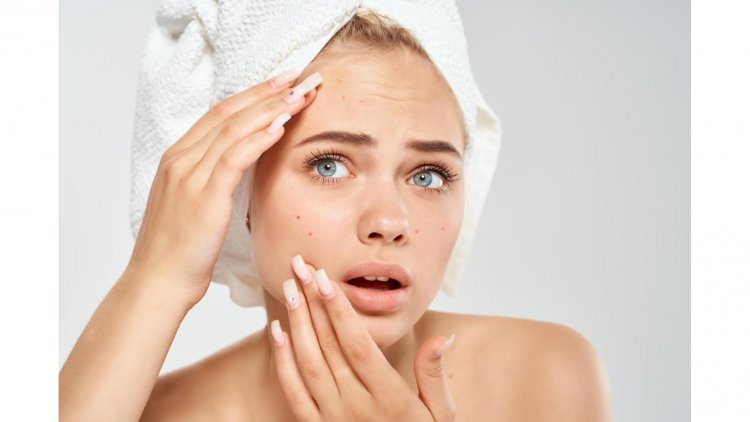 Unmasking the Truth: The Real Culprits Behind Acne