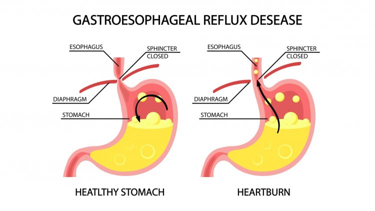 Taming Acid Reflux: 8 Savvy Strategies to Soothe Your Symptoms Naturally