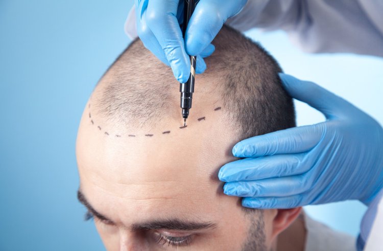 Unlocking the Mysteries of Hair Transplants: From Follicle to Future