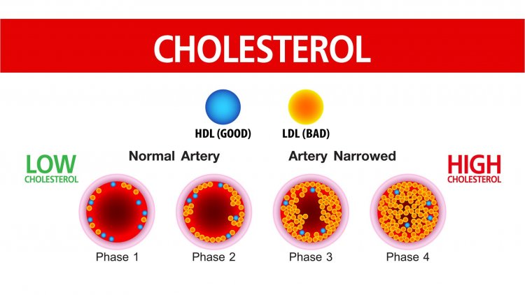 The Cholesterol Conundrum: Decoding Its Impact on Heart Health