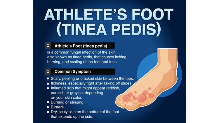 Conquering Athlete’s Foot: Natural Remedies to Keep Your Feet in Top Shape