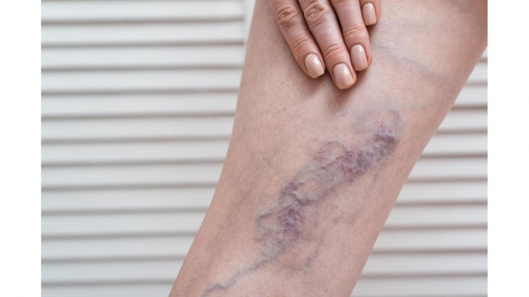 Thrombosis-Free Living: 5 Health Tips for a Stronger, Healthier Circulatory System